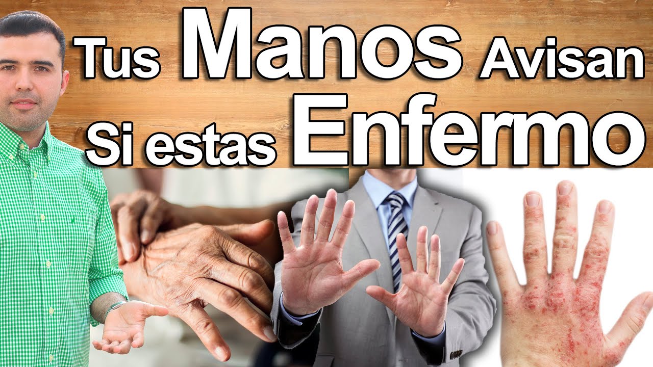 manchas en la palma de las manos